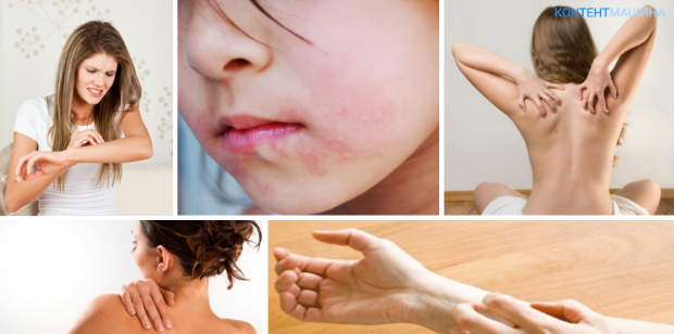 Аллергия – болезнь или особенность организма?