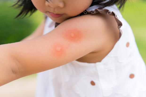 Как жить родителям ребенка с аллергией: советы и правила