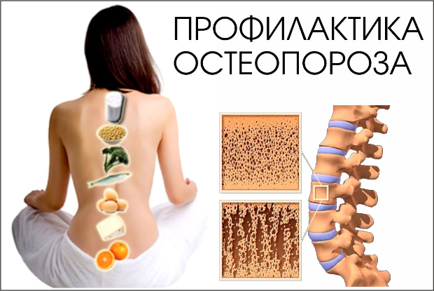 Профилактика остеопороза. Как сохранить свои кости целыми? 